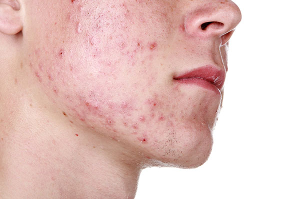 Accutane